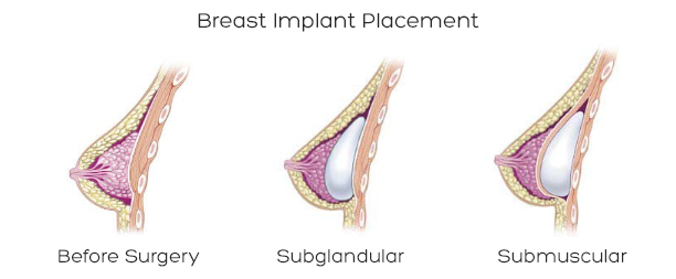 Breast Implant Placement: Submuscular vs Subglandular
