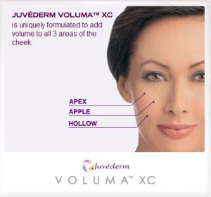 Juvederm Voluma XC: With optimal treatment its results may last up to 2 years.