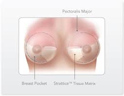 Pectoral Major, Breast Implant Pocket, Strattice