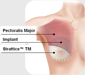 Pectoral Major, Breast Implant, Strattice