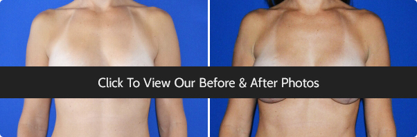 Can A Breast Augmentation Fix Sagging Breasts?