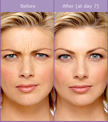 Botox Treatment of face - Before & After Photo