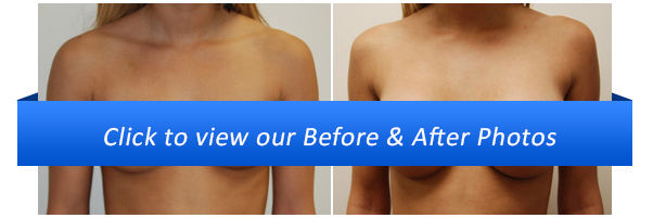 Breast Augmentation Before & After Photo Gallery