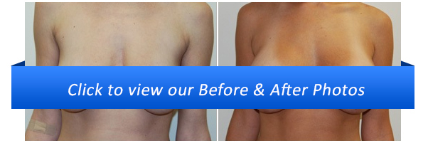 How Long Does It Take Breast Lift Incisions To Heal?