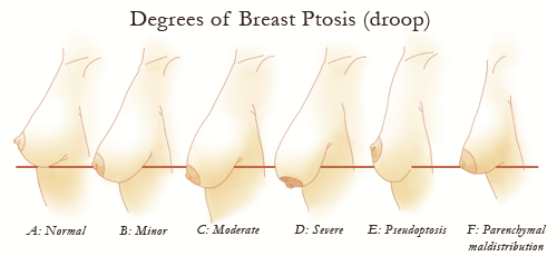 Breast Ptosis, Droopy Breasts, Saggy Breasts