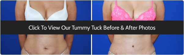 Tummy Tuck Surgery Before & After Photos