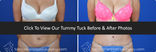 Tummy Tuck Before and After Photos