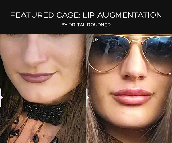 Featured Case: Lip Augmentation - Performed by Dr. Tal Roudner in Miami FL.