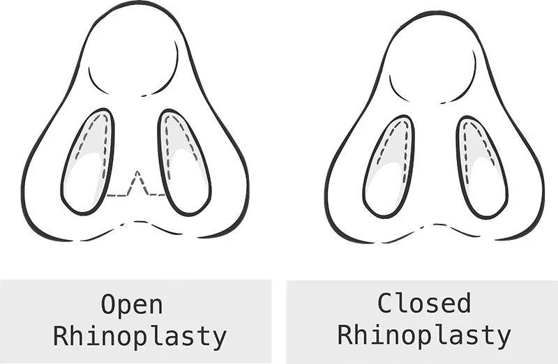 Open and Closed Rhinoplasty illustration