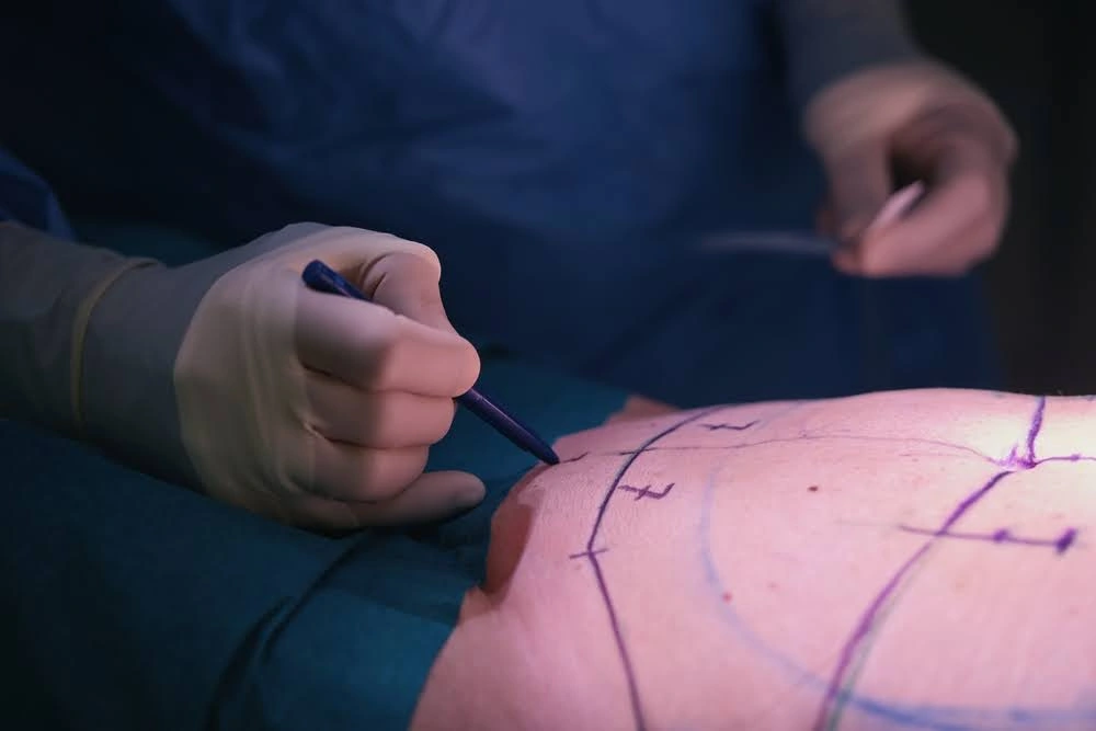 experienced surgeon marking up a woman's stomach before a tummy tuck