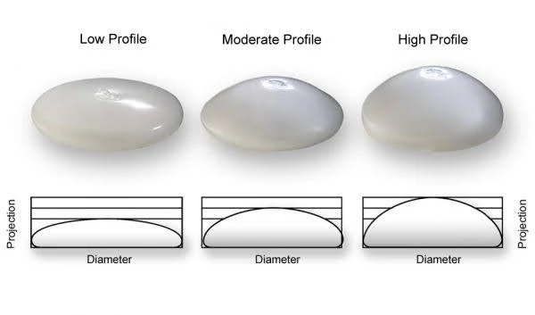 graphic depicting different implant types