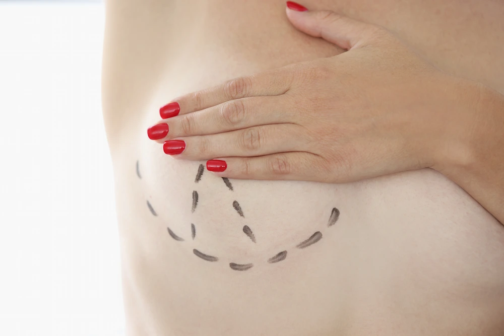 Woman holding her breast and displaying incision lines